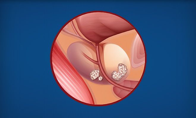 Diagram of prostate cancer