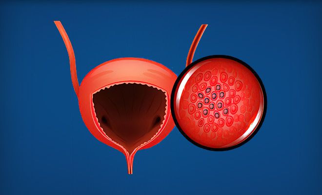 Diagram of bladder cancer