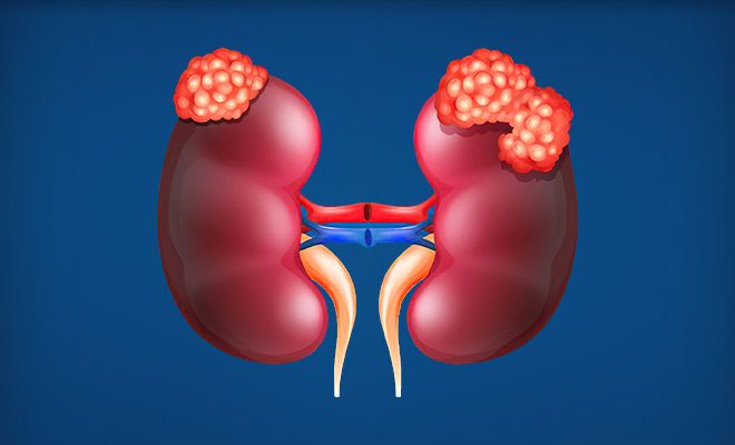 Diagram of kidney cancer