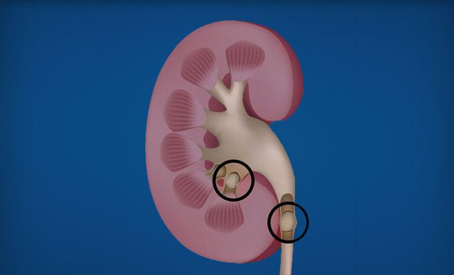 Diagram of kidney stone removal
