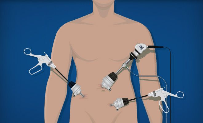 Diagram of laparoscopic surgery