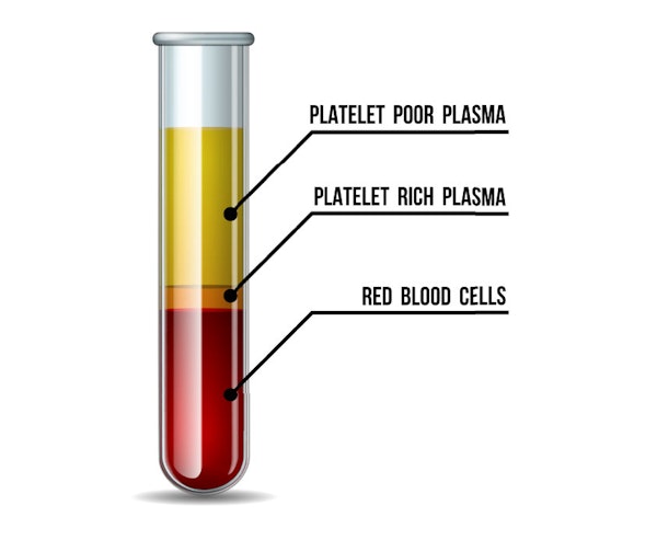 Vial that shows platelet poor plasma, platelet rich plasma, red blood cells from top to bottom