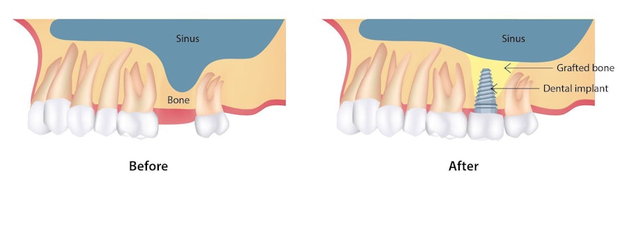 Before and after illustrations of a sinus lift