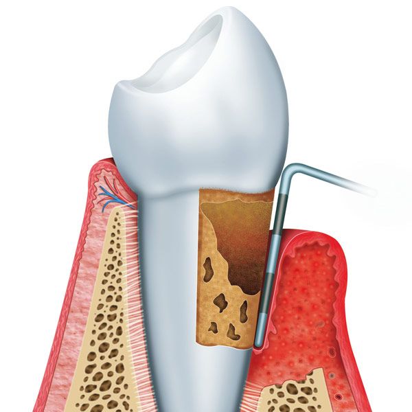 Illustration of scaling and root planing treatment