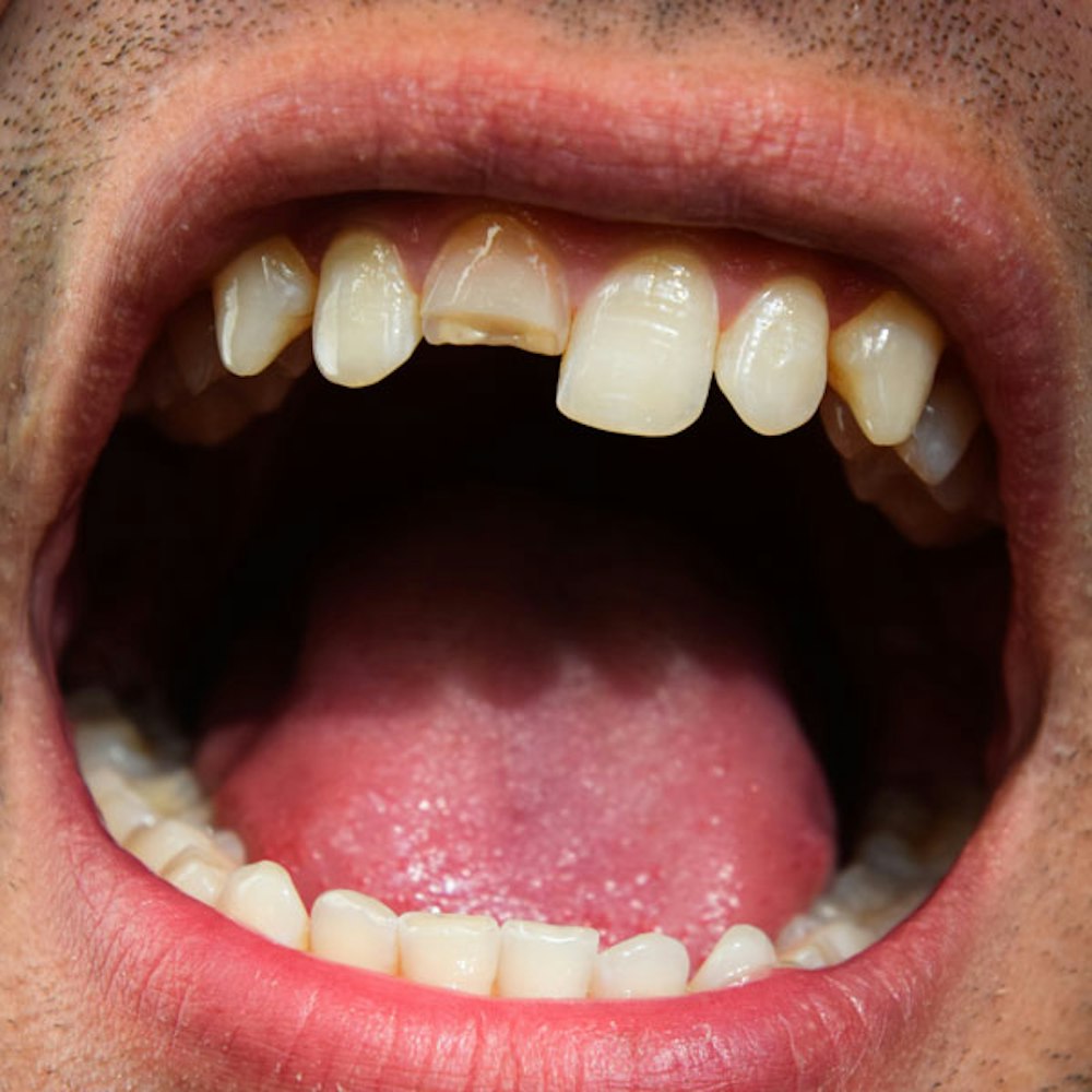 Severely Damaged Teeth