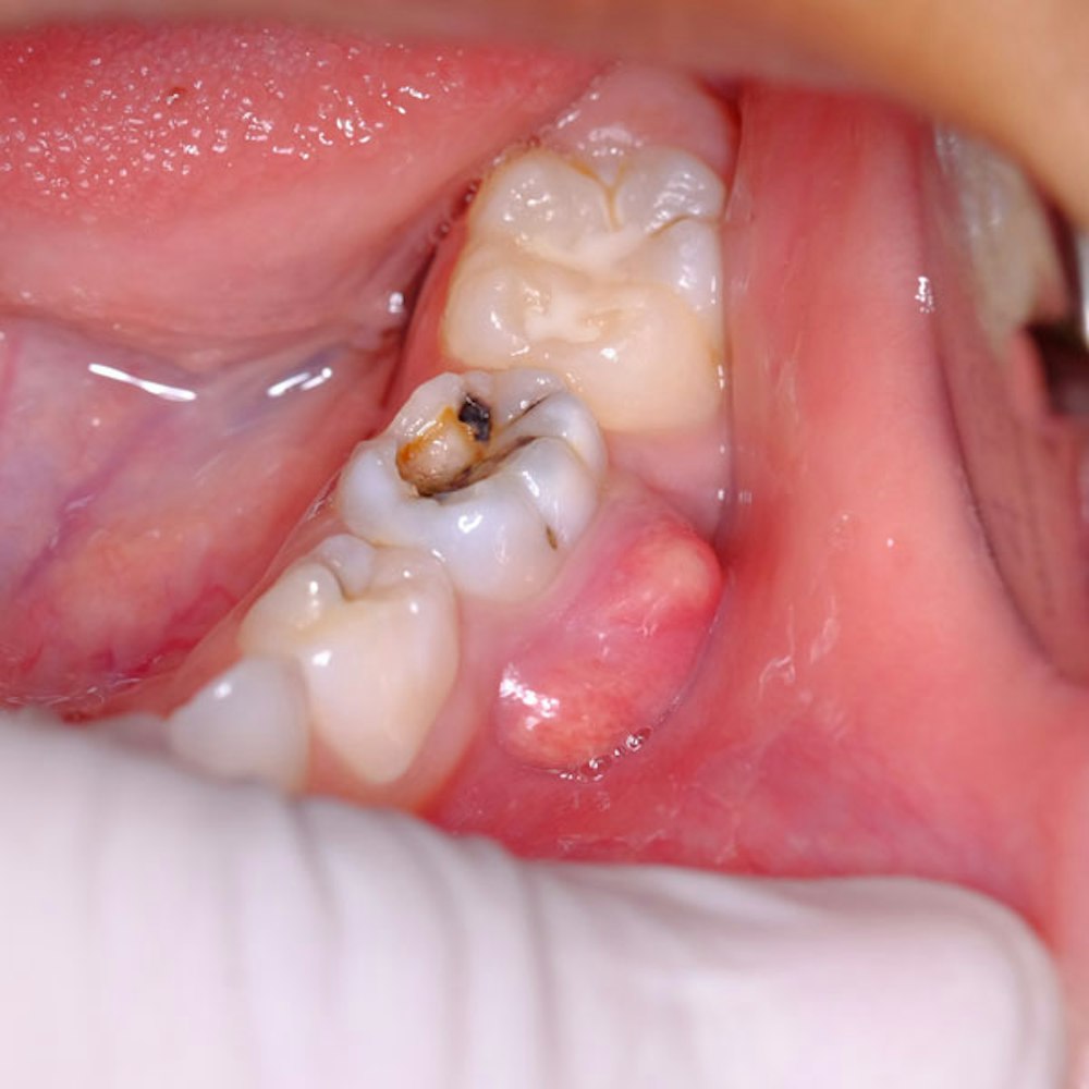 Severe Dental Abscess