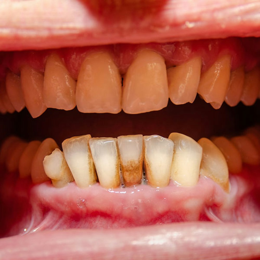 Advanced Gum Disease