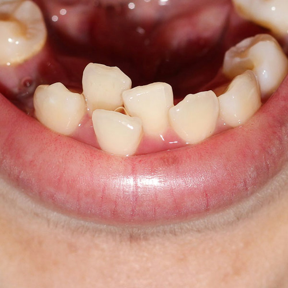 Crowded Teeth