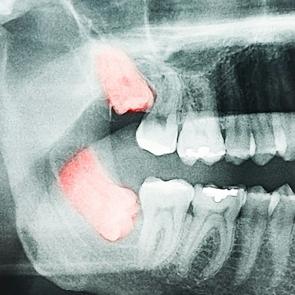 Wisdom Teeth