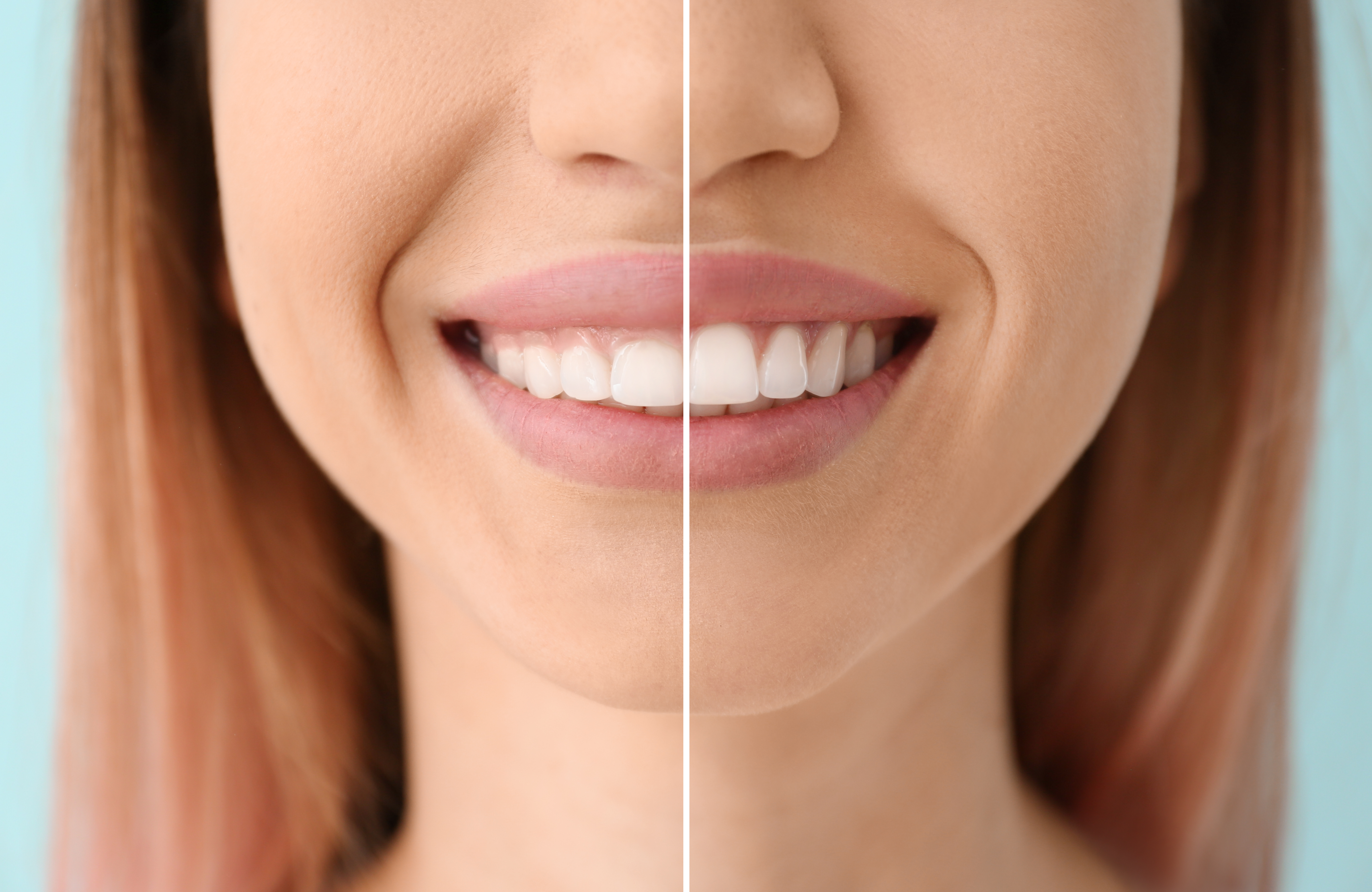 Smile before and after gum contouring