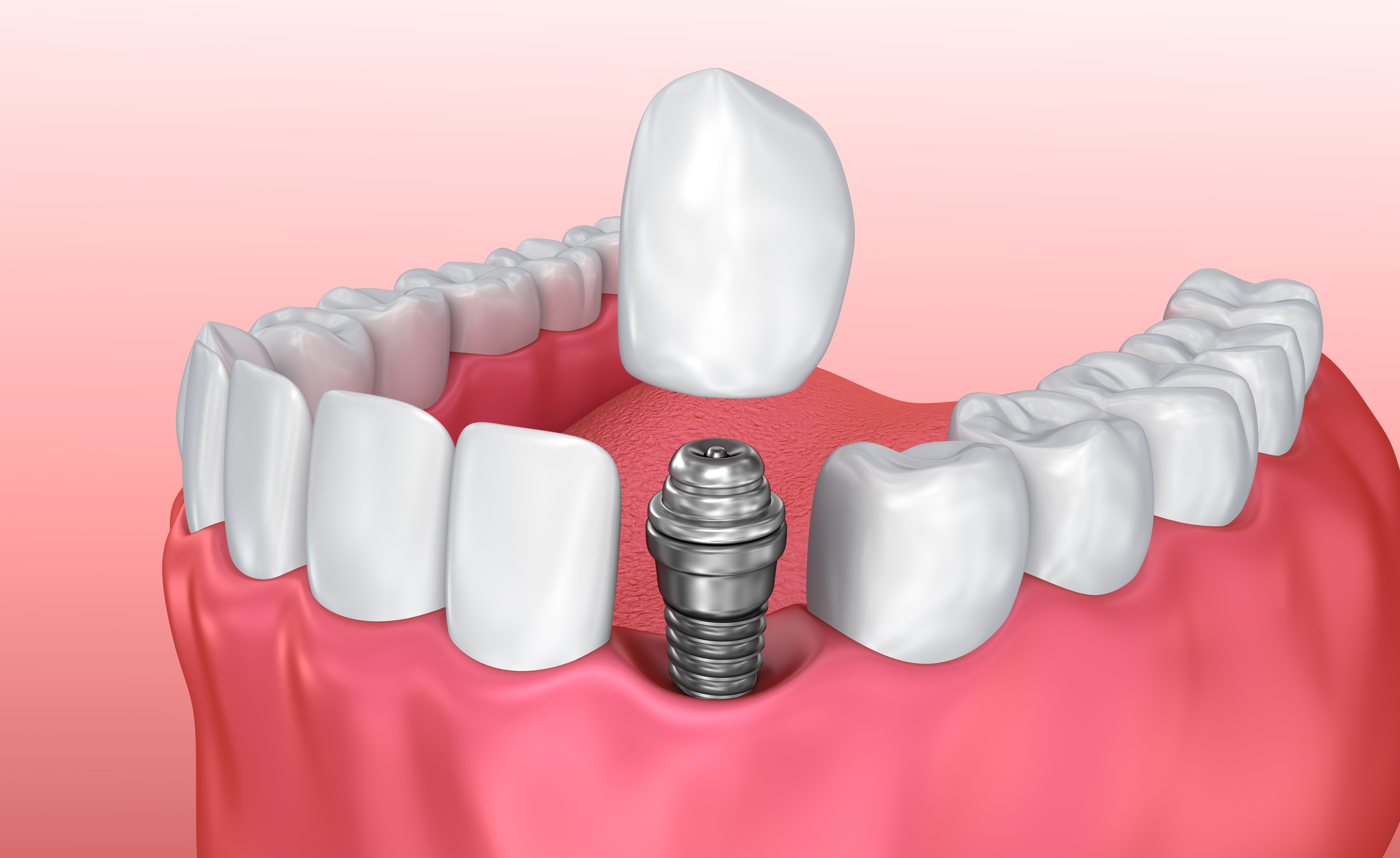 Illustration of implant and crown being placed