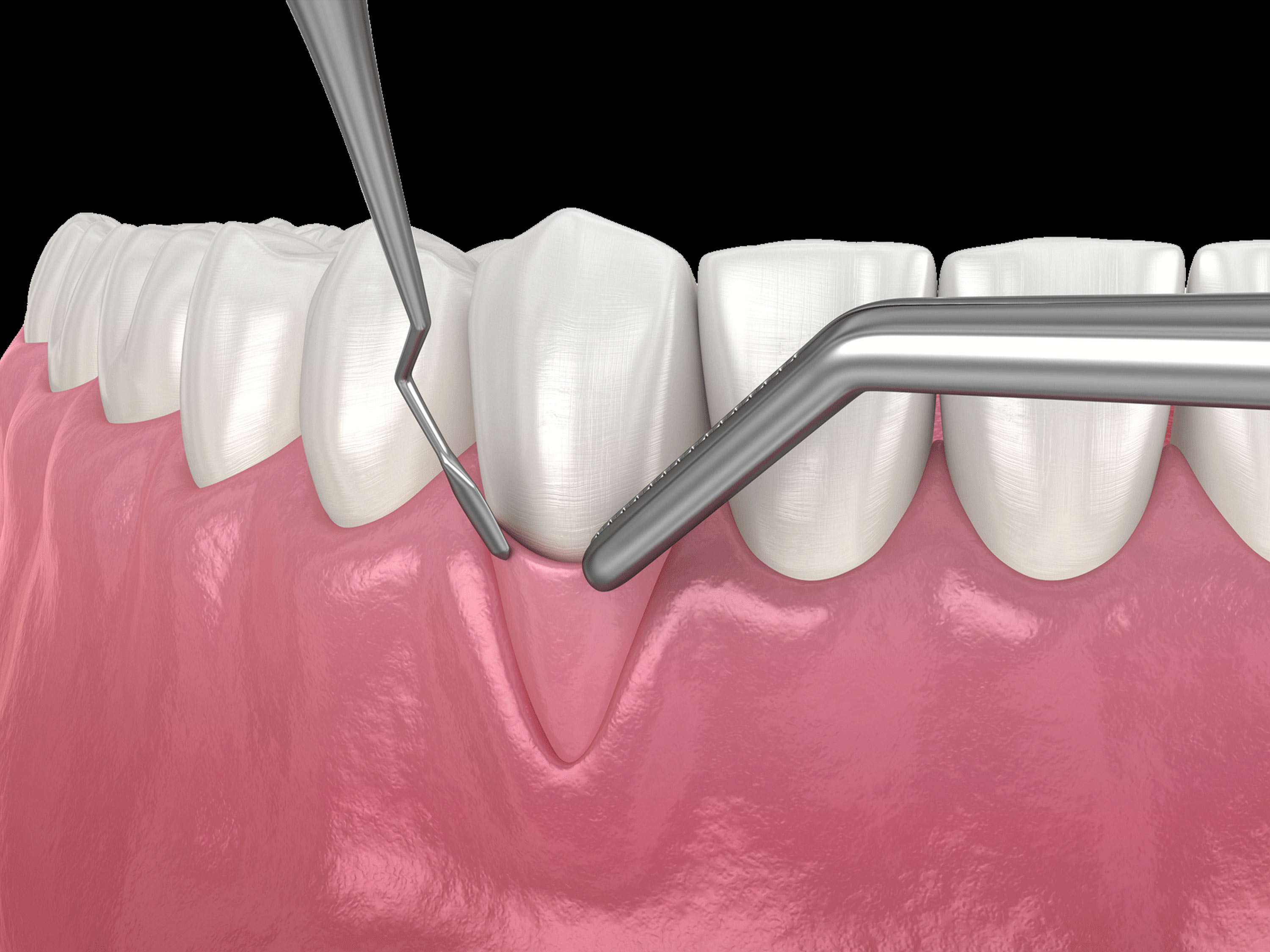 gums with thin tissue