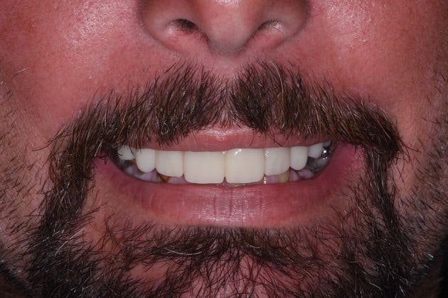 after dental implants