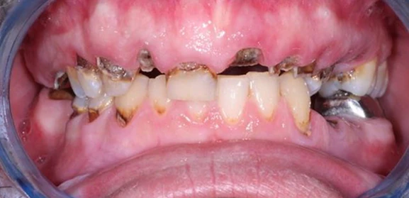 Real patient photo of before dental implant treatment
