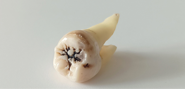 model of extracted tooth
