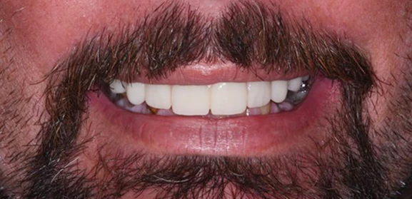 Real patient photo after dental implant treatment