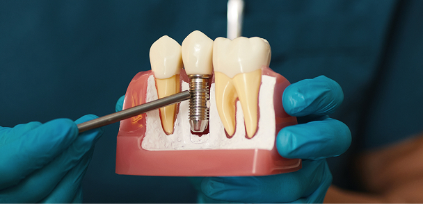 Model Dental Implants