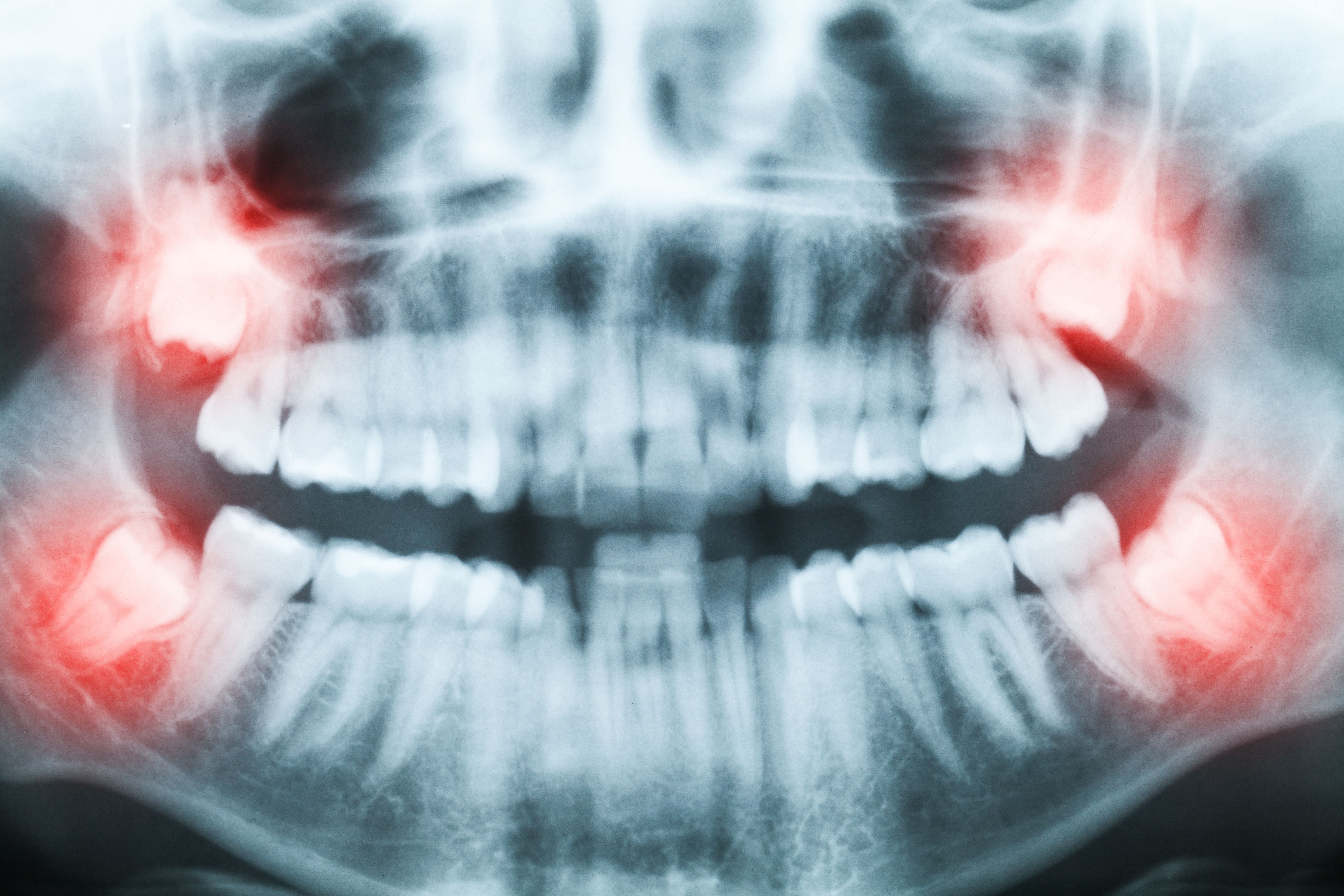 wisdom teeth x-ray