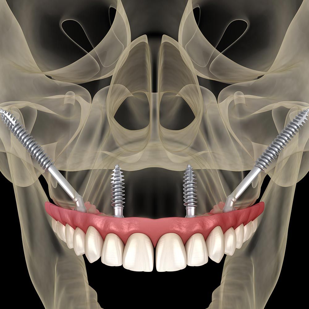 Allon4 Dental Implants Bountiful, UT Layton, UT Murray, UT