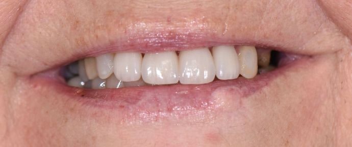 Case 3 after procedure