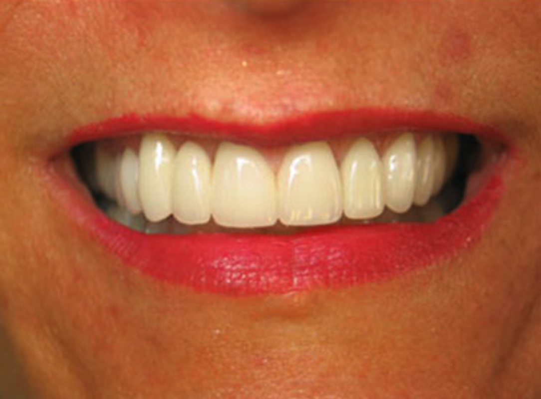 After veneers