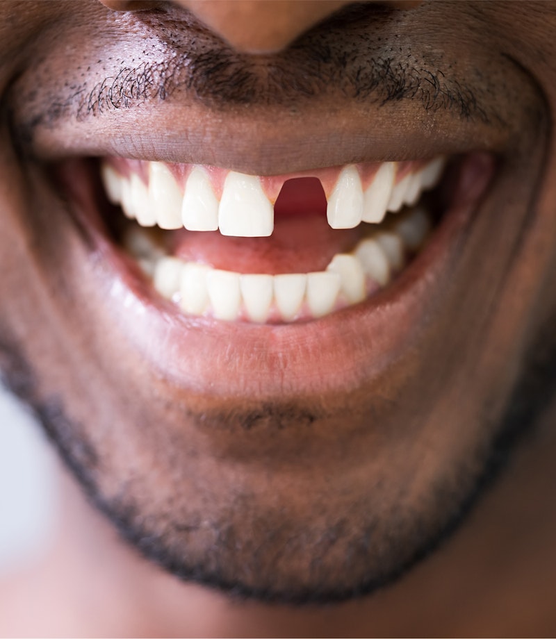 man with missing tooth
