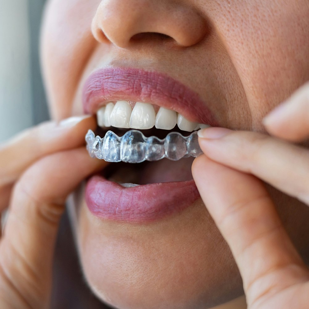 a person placing Invisalign on teeth