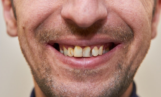 Close-up of a damaged smile
