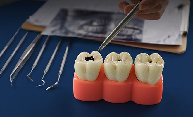 close-up of dentist pointing at a model of a cavity