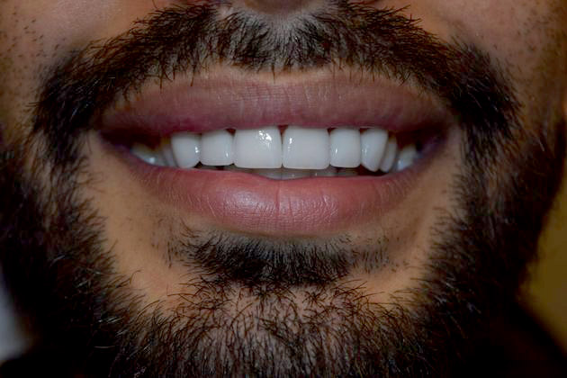 After veneers
