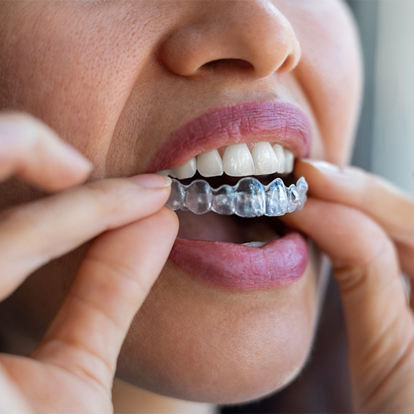 closeup of person placing their Invisalign tray