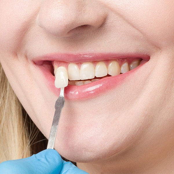 Veneer against tooth