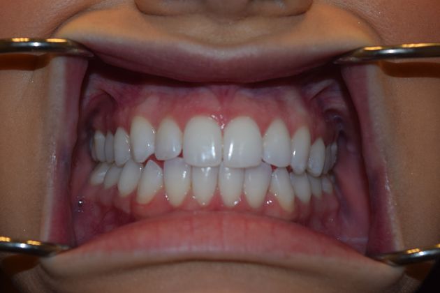case 5 after invisalign