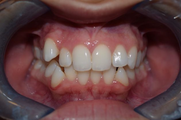 case 5 before invisalign