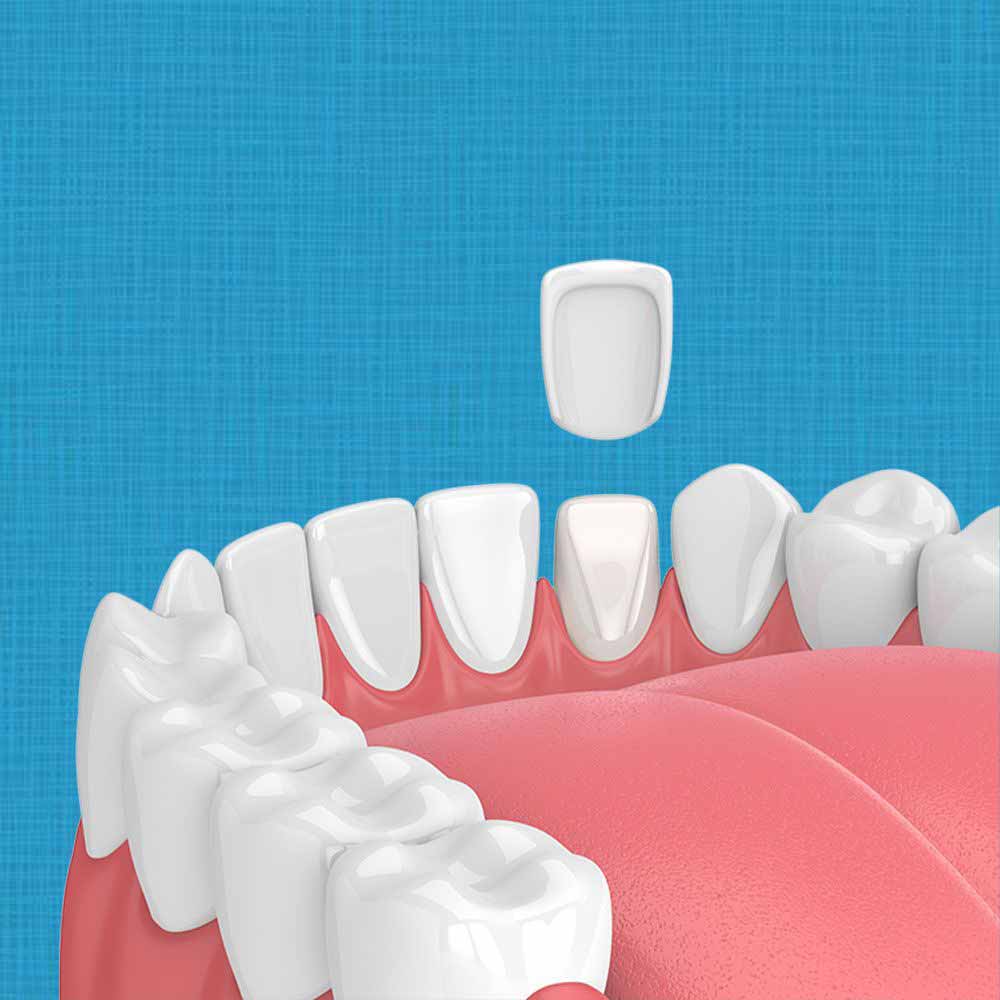 Porcelain veneer fitting onto tooth