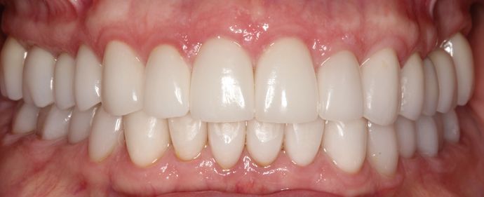 Sonoran Dental Design patient's white straight teeth after cosmetic dentistry