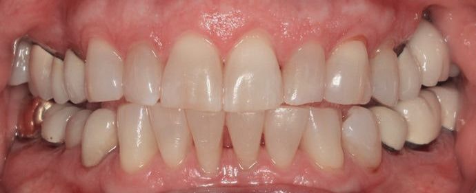 Sonoran Dental Design patient's yellow teeth before cosmetic dentistry