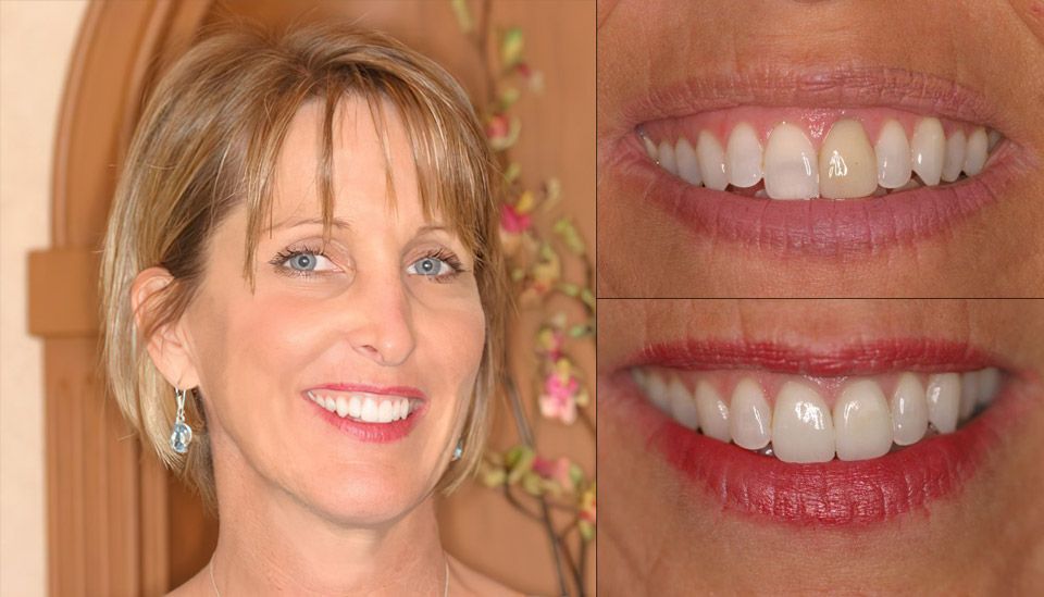dental crown patient