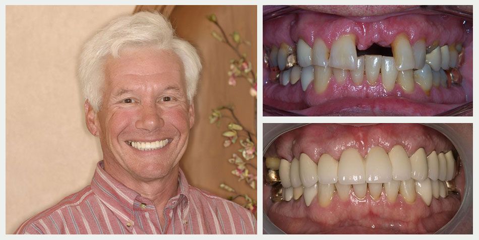 Collage of Case 8 patient's before and after dental implant surgery