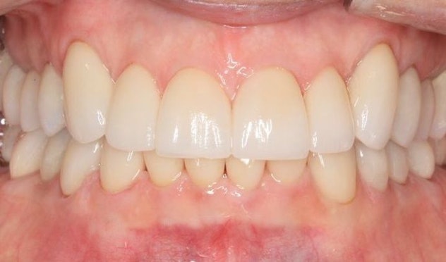 Before a Full Mouth Reconstruction