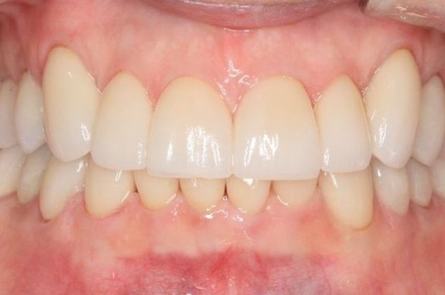 Before a Full Mouth Reconstruction