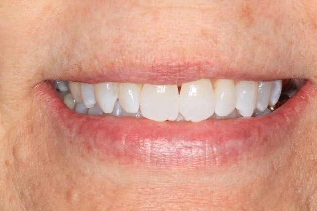 Sonoran Dental Design patient's misshapen and chipped front teeth