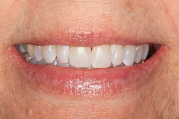 Sonoran Dental Design patient's perfected front teeth after dental bonding