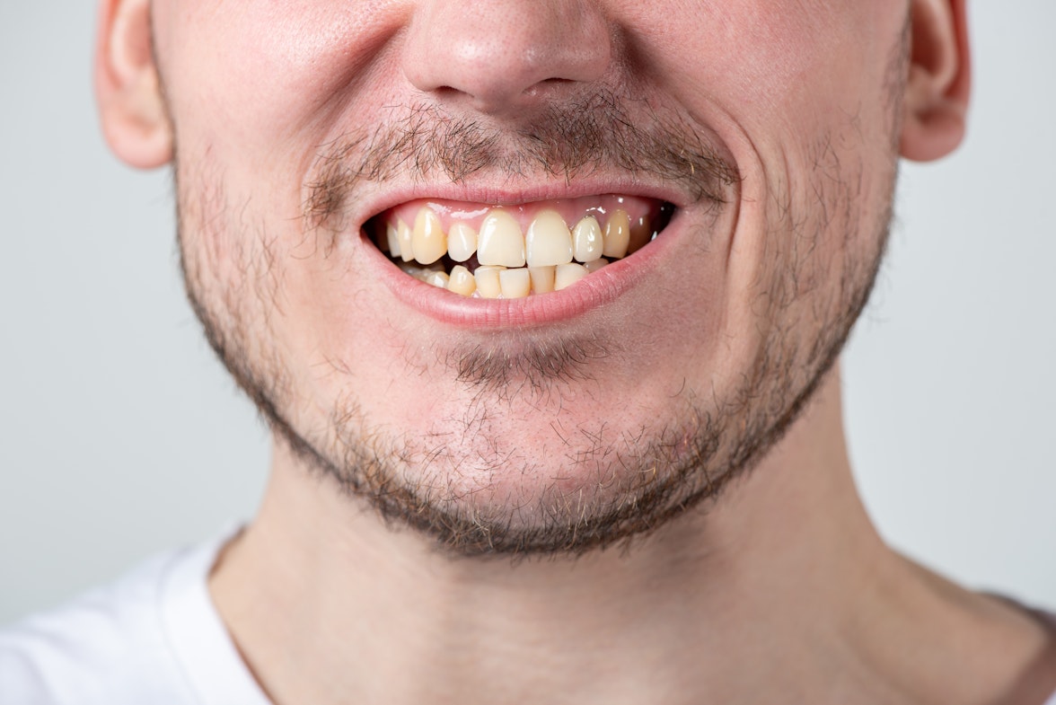 Man with crooked, yellow teeth