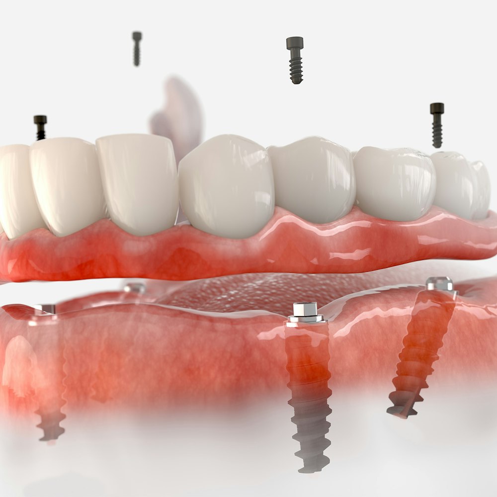 Implant-supported dentures