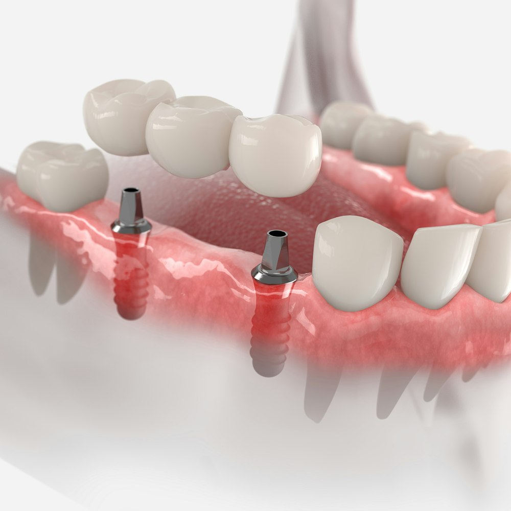 implant-supported bridge
