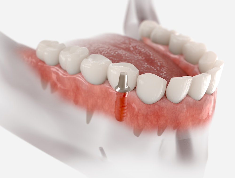 Dental implant