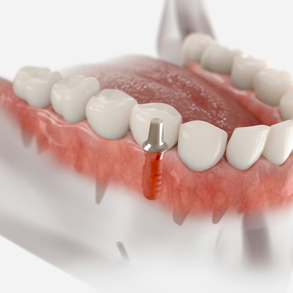 Dental implant