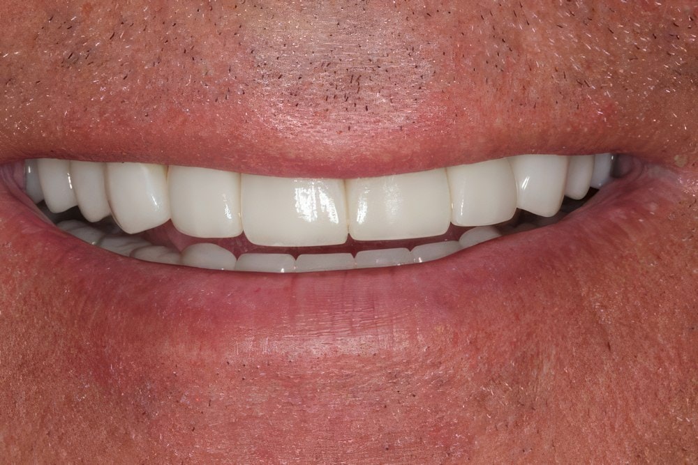 The beneficial results of a full mouth restoration