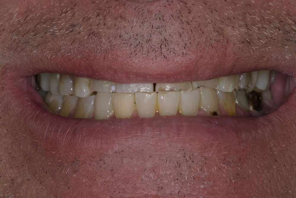 Full Mouth Reconstruction Scottsdale, AZ - Sonoran Dental Design